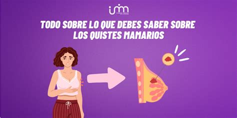 ilustración que muestra un conducto mamario obstruido y cómo masajear la zona