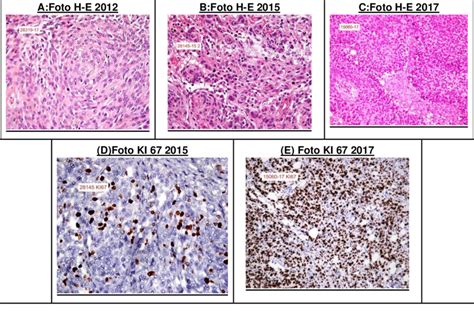 Microfotografía que muestra los cambios histopatológicos de la VIN III, incluyendo hiperqueratosis, engrosamiento epitelial y atipias celulares.