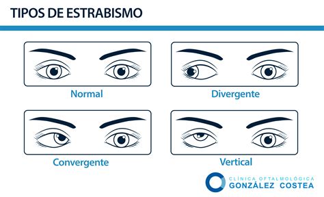 Infografía comparativa: alineación visual normal frente a estrabismo convergente y divergente.