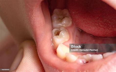 Foto de diente de leche con caries