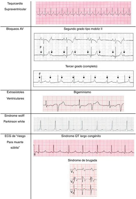 ejemplos de trazados electrocardiográficos relevantes en la práctica clínica pediátrica (taquicardia supraventricular, extrasístole ventricular, síndrome de Wolff-Parkinson-White)