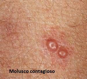 Esquema visual mostrando la apariencia de las pápulas del molusco con su característica umbilicación central