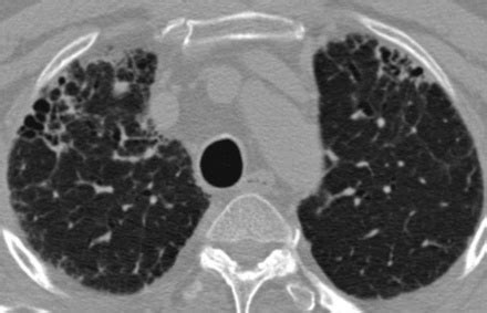 Imagen de TC pulmonar de alta resolución mostrando patrón en panal de abeja característico de fibrosis avanzada