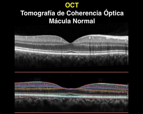 Imagen de Tomografía de Coherencia Óptica (OCT) mostrando estructura en panal de abeja en una arteria coronaria afectada por enfermedad en entramado