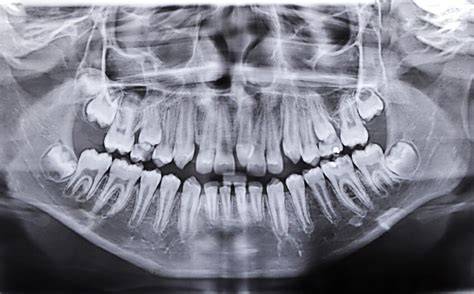 Radiografía panorámica mostrando un mesiodens y apiñamiento dental