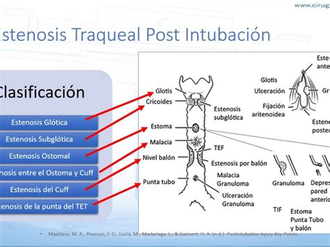Esquema de las diferentes técnicas quirúrgicas para la estenosis traqueal pediátrica