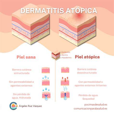 Esquema de una piel con dermatitis atópica con inflamación y sequedad
