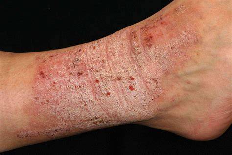 Fotografía de piel con liquenificación debido al rascado crónico en eczema