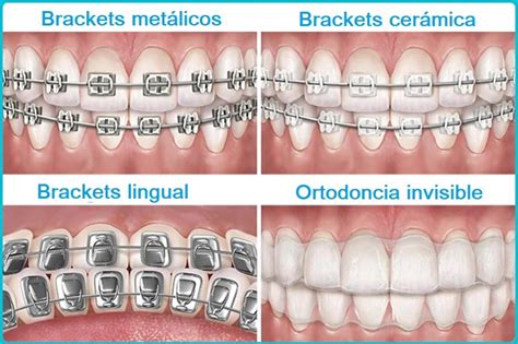 diagrama comparativo de diferentes tipos de ortodoncia (brackets estéticos, alineadores, lingual)
