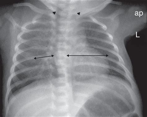 Radiografía de tórax neonatal mostrando fracturas en los arcos costales izquierdos.