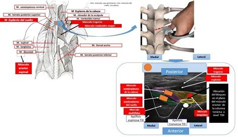 Ilustración esquemática de la anatomía del bloqueo del plano del erector de la espina (ESPB).