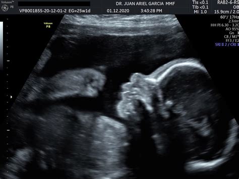 Ecografía 2D de un feto en el útero materno, mostrando detalles anatómicos.