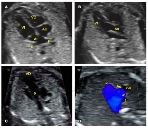 Diagrama mostrando la correcta visualización del corazón fetal en cuatro cámaras durante la ecografía morfológica.