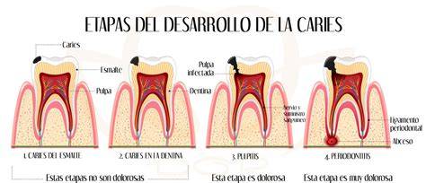 Esquema de la progresión de la caries dental en un diente de leche
