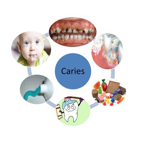 Infografía sobre los factores de riesgo de caries infantil