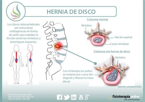 Infografía comparativa: una vértebra sana frente a una con hernia de disco que comprime la raíz nerviosa.