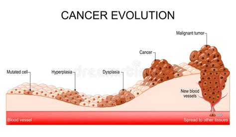 Ilustración de las etapas de desarrollo del cáncer: hiperplasia, displasia, carcinoma in situ y tumor maligno