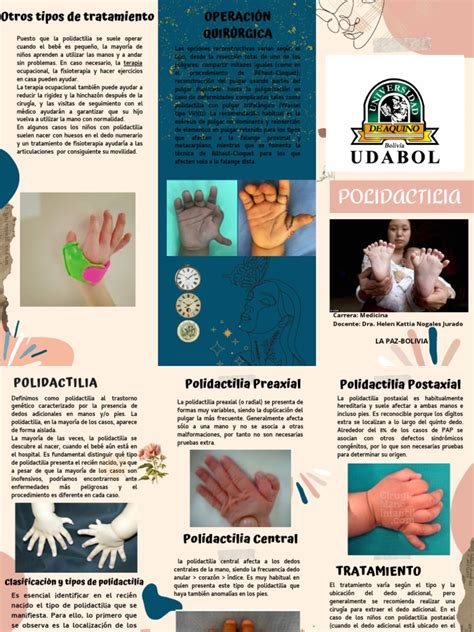 Infografía comparativa que muestra las tres localizaciones principales de la polidactilia: preaxial, central y postaxial.