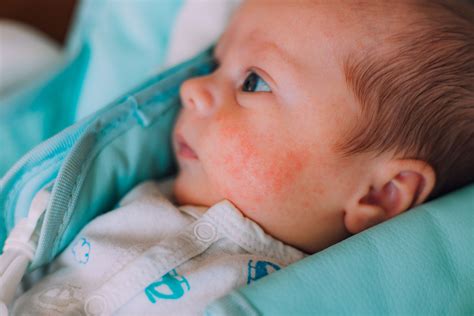 Fotografía de un bebé con eritema tóxico neonatorum mostrando máculas eritematosas con pápulo-pústulas.