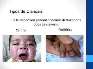 Imagen comparativa de acrocianosis periférica y cianosis central en un recién nacido.