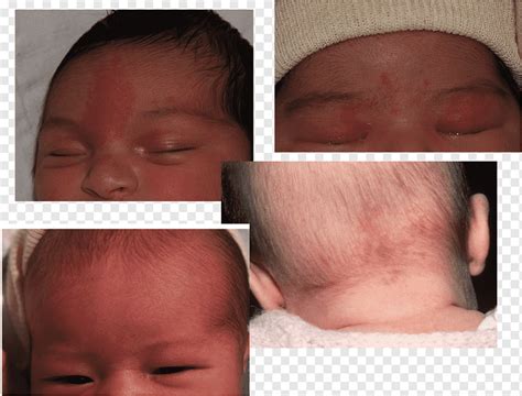 Imagen de un bebé con nevus flammeus en la cara, compatible con síndrome de Sturge-Weber.