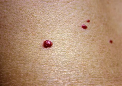 Fotografía de un hemangioma tipo fresa en la pared abdominal de un bebé.