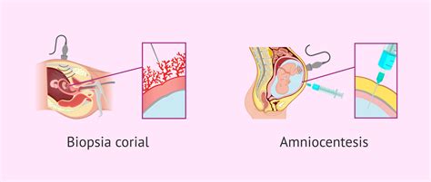 Infografía comparativa de la biopsia corial y la amniocentesis, destacando sus diferencias en tiempo de realización, procedimiento y riesgos.