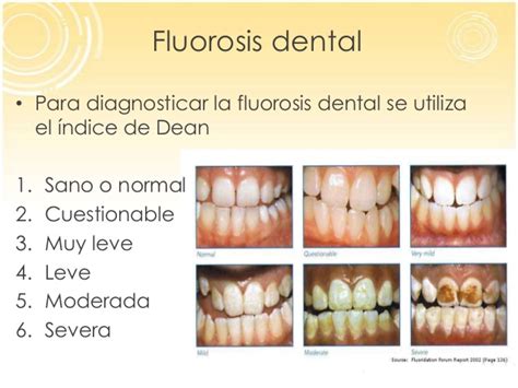 Imágenes de fluorosis dental, mostrando la variabilidad desde leve a severa.