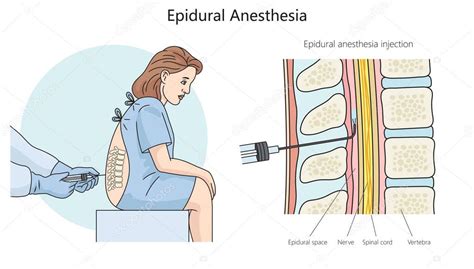 Ilustración del procedimiento de analgesia epidural