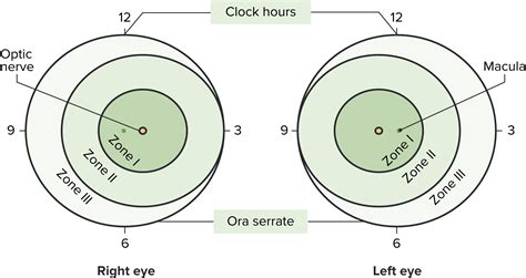 Representación esquemática de las zonas y horas del reloj en la retinopatía del prematuro.