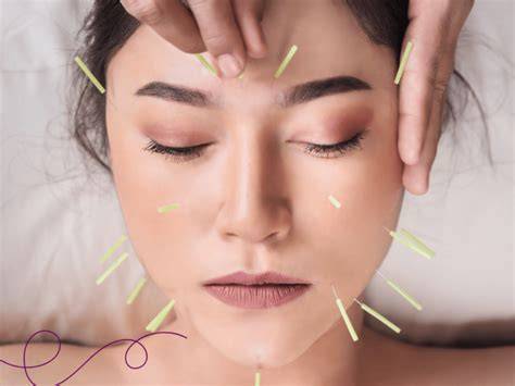 Ilustración de una mujer realizando acupuntura para aliviar alergias
