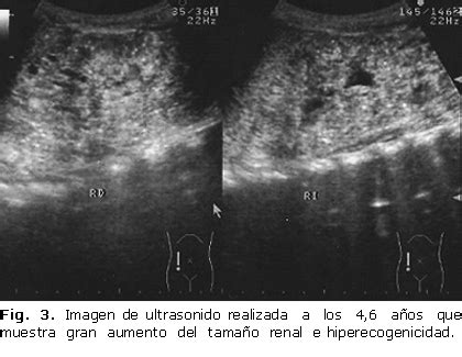 Ecografía fetal de riñones hiperecogénicos