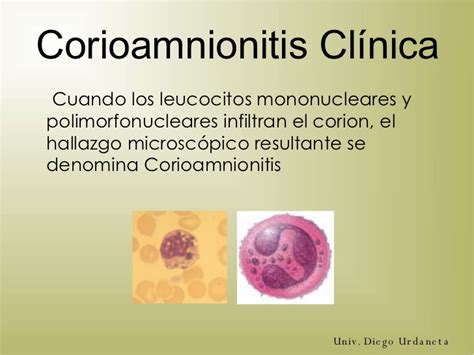 Fotografía de microscopio de corioamnionitis histológica
