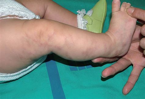 Lesiones cutáneas reticuladas de cutis marmorata telangiectásica congénita en la extremidad inferior derecha