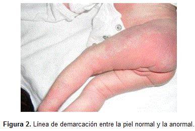 Evolución de lesiones de cutis marmorata telangiectásica congénita con hipotrofia de la extremidad inferior izquierda