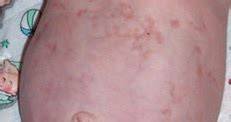 Distribución generalizada de lesiones de cutis marmorata telangiectásica congénita con hemihipertrofia corporal izquierda