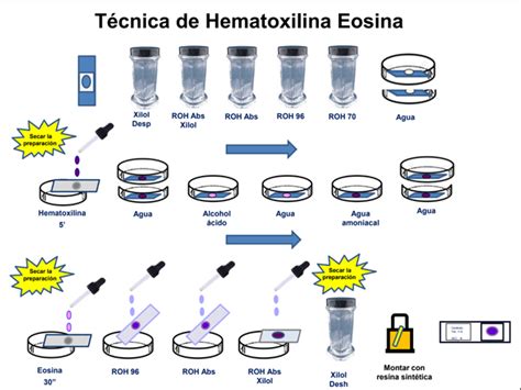 Tinción de muestra con hematoxilina-eosina mostrando aumento del número y tamaño de capilares y vénulas