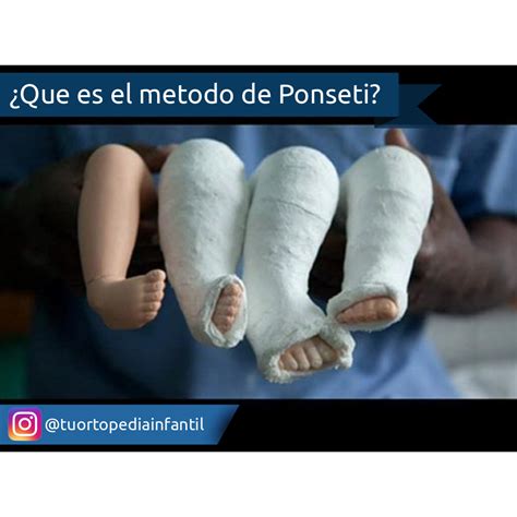 Infografía detallando las cuatro fases del Método Ponseti: manipulación, enyesado, tenotomía percutánea y ferulización.