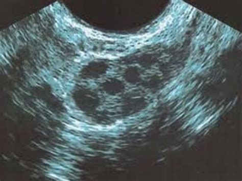 Ecografía transvaginal mostrando múltiples folículos antrales de pequeño tamaño en un ovario.