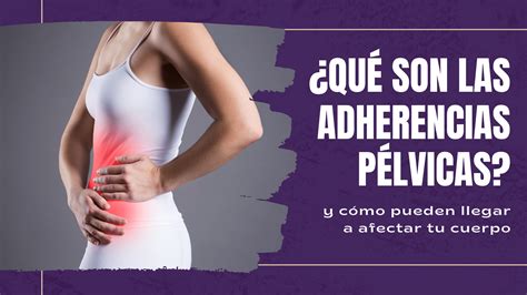 Diagrama de adherencias pélvicas y ováricas
