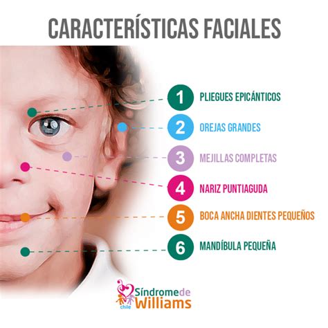 Foto ilustrativa de los rasgos faciales típicos del Síndrome de Williams