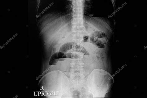 Radiografía abdominal mostrando una obstrucción intestinal por un objeto extraño
