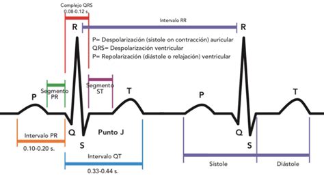 Ejemplo de un electrocardiograma (ECG) con marcas que señalan las ondas P, QRS y T, y una posible extrasístole.