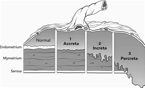 Esquema de las diferentes profundidades de invasión de la placenta accreta, increta y percreta