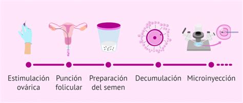 Esquema de la técnica ICSI mostrando la inyección de espermatozoide en el óvulo