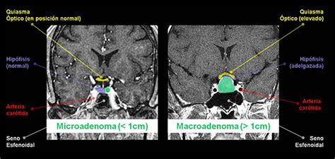 Imagen de resonancia magnética que muestra un adenoma hipofisario