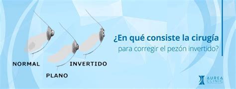 Comparativa visual de pezón normal, plano e invertido.
