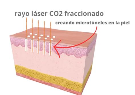 Esquema de las capas vaginales y la acción del láser CO2