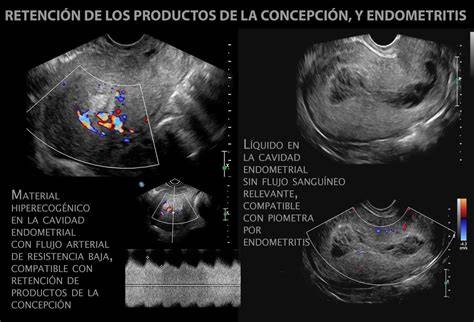 Ecografía transvaginal mostrando productos retenidos de concepción
