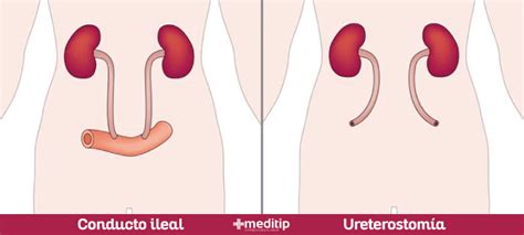 Diagrama mostrando la creación de un conducto ileal para urostomía.